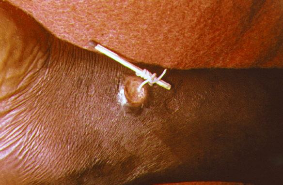 Santé : cinq choses à savoir sur la maladie du ver de Guinée