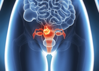 Cancer du col de l’utérus : les chiffres sont alarmants