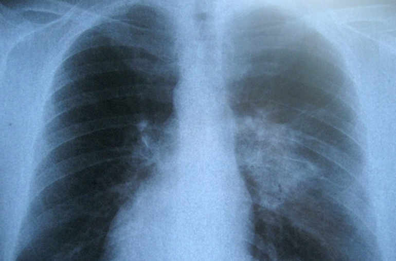 Lutte contre la tuberculose : environ 70 % des cas diagnostiqués et traités en Afrique