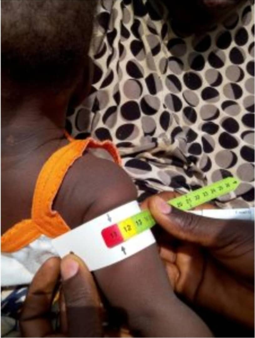 Health: malnutrition, a disease that has become recurrent among children under five in Chad