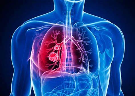 Lutte contre la tuberculose : l’ONU et les Etats membres s’engagent à mettre fin à cette épidémie