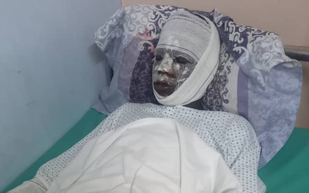 Cameroun : Un étudiant tchadien en état de détresse après un court-circuit à Douala