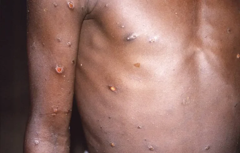 Huit pays africains ont déclaré des cas de variole du singe selon l’OMS